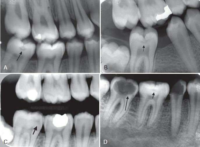 Quy trình chụp X quang răng được thực hiện như thế nào? - ảnh 3