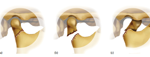 Quy trình chụp cắt lớp vi tính hàm mặt có dựng hình 3D có tiêm thuốc cản quang - ảnh 1