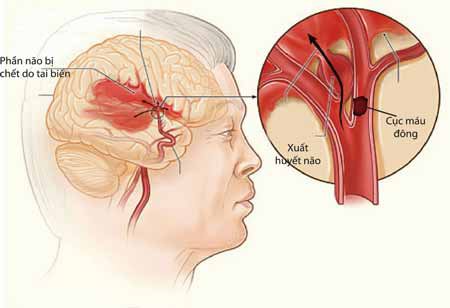 Xuất huyết nội tạng: Nguyên nhân và triệu chứng - ảnh 3