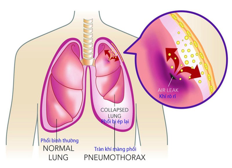 Hướng dẫn cách điều trị hội chứng suy hô hấp cấp nguy kịch - ảnh 1
