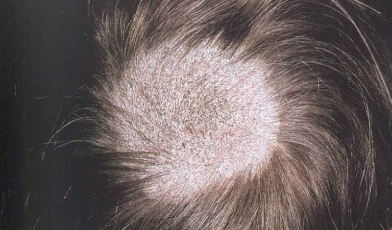 Bệnh nấm tóc: Nguyên nhân, triệu chứng và cách điều trị