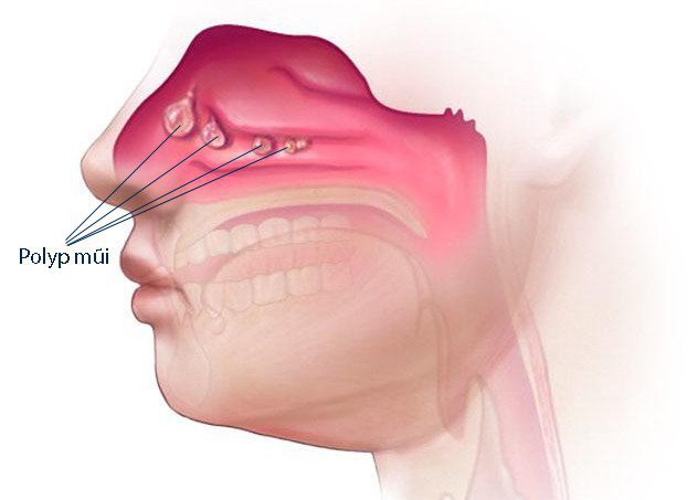 Gây mê nội khí quản cắt polyp mũi - ảnh 2