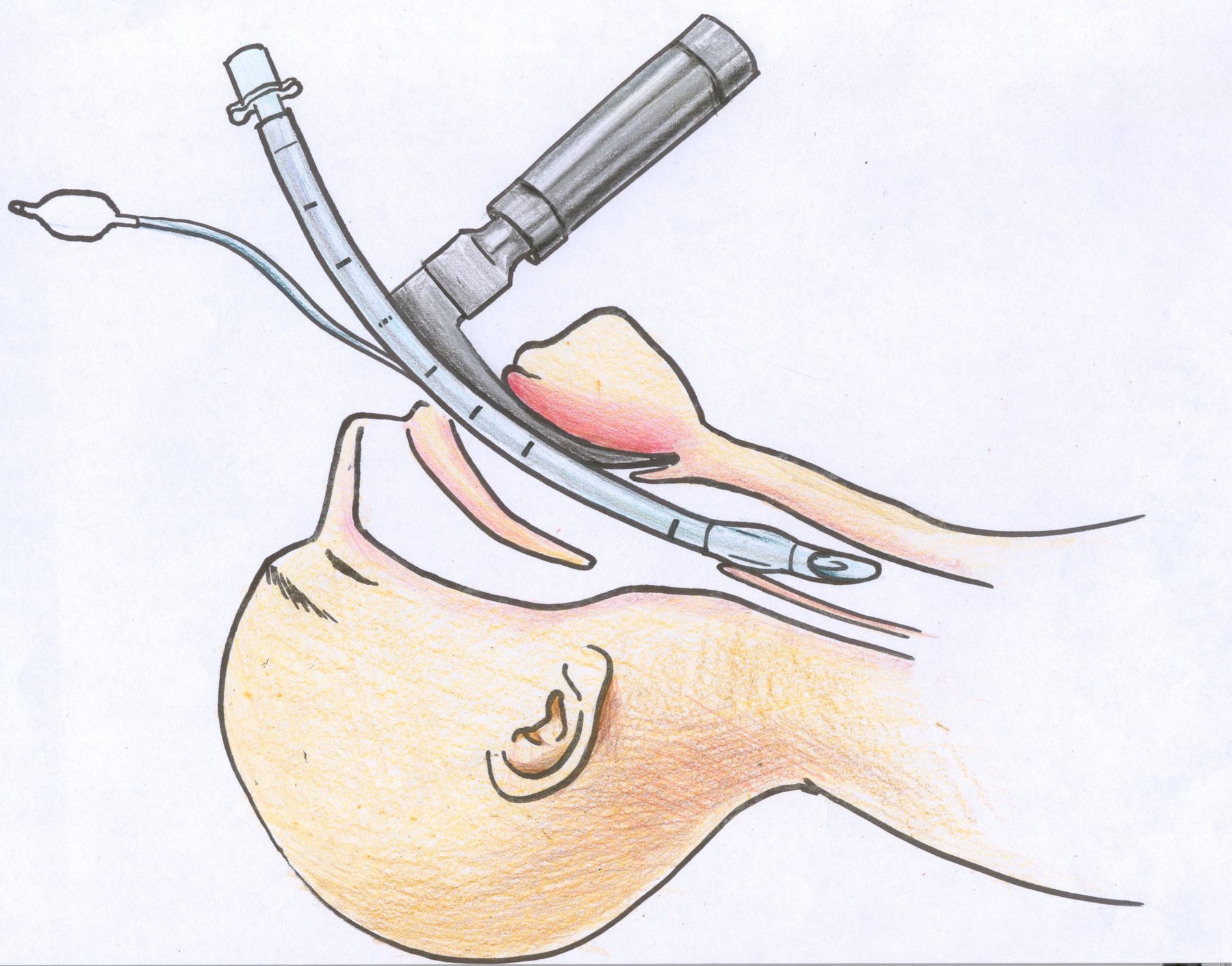 Gây mê nội khí quản cắt u da lành tính vành tai - ảnh 2