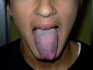 Lưỡi lông đen: Nguyên nhân, triệu chứng - ảnh 1
