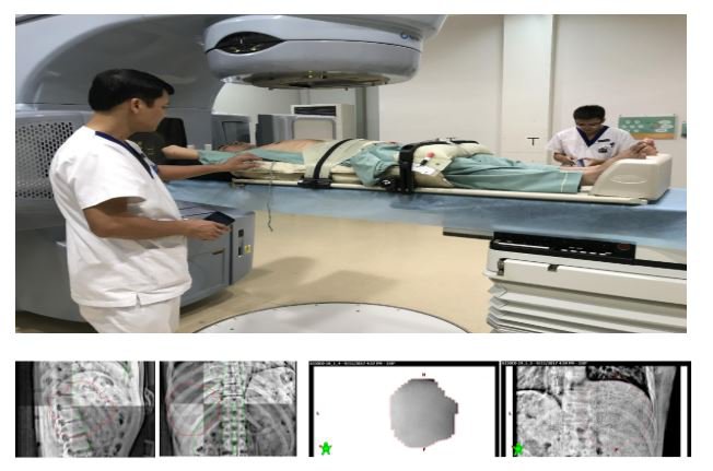 Xạ trị công nghệ cao - kỹ thuật xạ phẫu định vị thân (SBRT) - ảnh 7