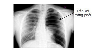 Kỹ thuật mở màng phổi tối thiểu - ảnh 1
