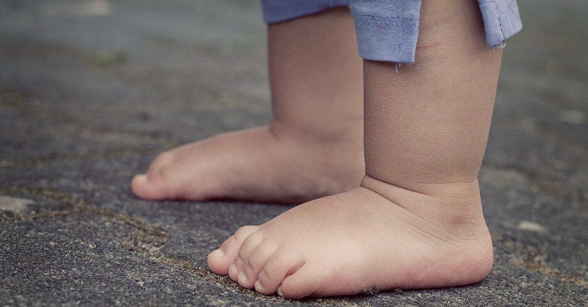 Các dị tật bàn chân thường gặp ở trẻ sơ sinh - ảnh 2
