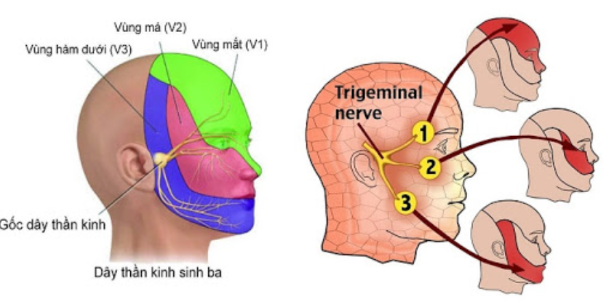 Đặc điểm cơn đau do u dây thần kinh số V - ảnh 1