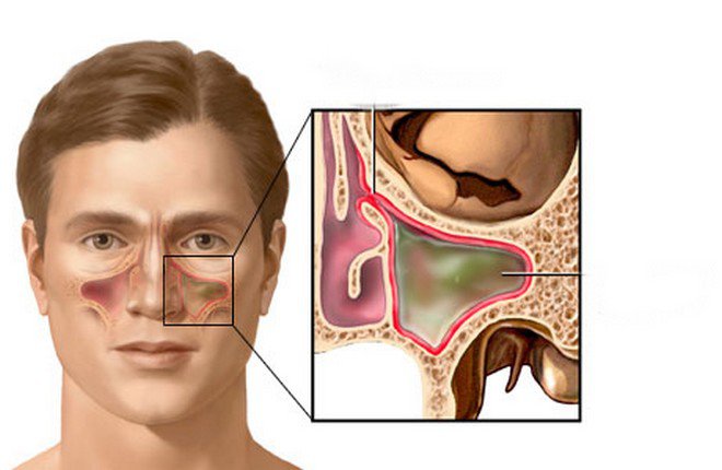 Chụp X Quang Hirtz trong chẩn đoán viêm xoang