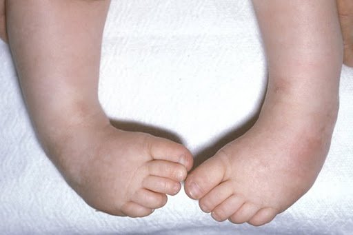 Các dị tật bàn chân thường gặp ở trẻ sơ sinh - ảnh 1