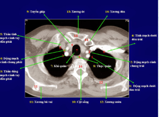 Quy trình chụp cắt lớp vi tính lồng ngực có tiêm thuốc đối quang i -ốt