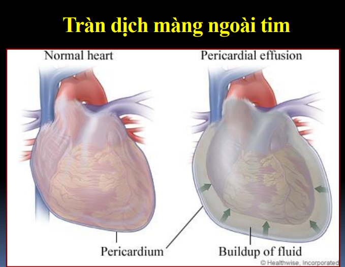 Ép tim cấp là gì? Các dấu hiệu nhận biết và điều trị - ảnh 3