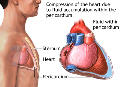 Ép tim cấp là gì? Các dấu hiệu nhận biết và điều trị