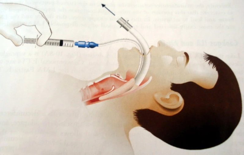 Quy trình gây mê mask thanh quản phẫu thuật nội soi cắt tuyến tiền liệt - ảnh 3