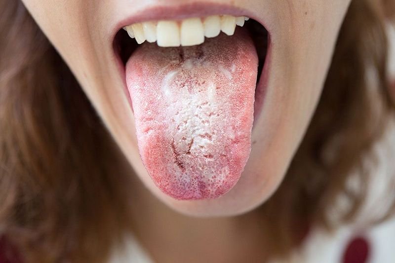 Nhiễm nấm Candida ở miệng, cổ họng và thực quản