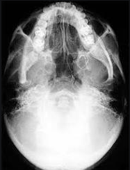 Chụp X Quang Hirtz trong chẩn đoán viêm xoang - ảnh 3
