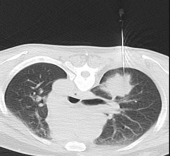 Sinh thiết phổi/màng phổi dưới cắt lớp vi tính