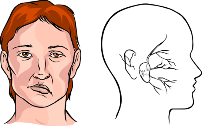 Quy trình gây mê mask thanh quản cắt toàn bộ tuyến mang tai, bảo tồn dây thần kinh số - ảnh 4